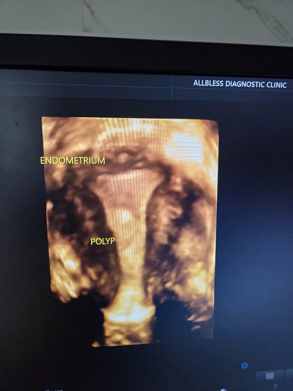 3D Pelvic Gynaec Ultrasound